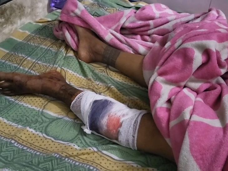 हजारीबाग में महिला से दुष्कर्म और मारपीट का आरोप:पैर टूटा; दो आरोपी गिरफ्तार, मेडिकल रिपोर्ट के बाद होगी रेप की पुष्टि