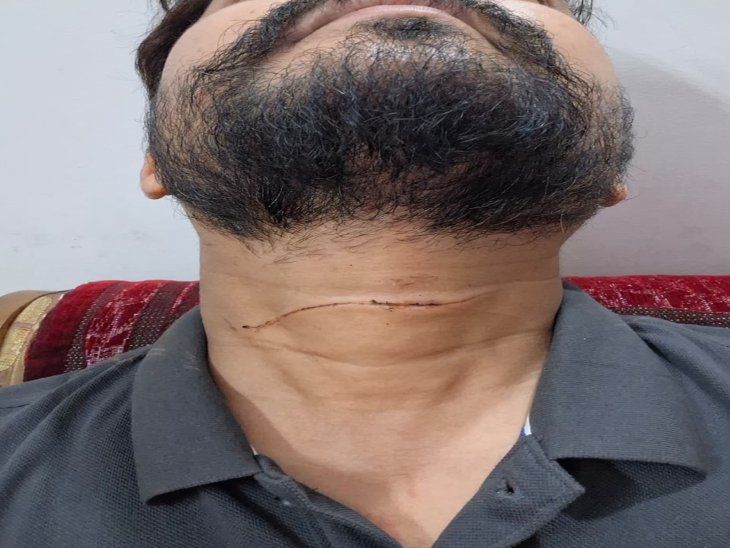 फ्लाईओवर पर युवक का गला चाइनीज मांझे से कटने से बचा, हेलमेट का फीता और नेकबैंड तक कटे